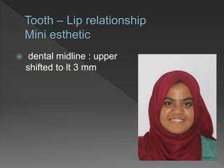  dental midline : upper
shifted to lt 3 mm
 