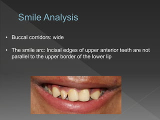 • Buccal corridors: wide
• The smile arc: Incisal edges of upper anterior teeth are not
parallel to the upper border of the lower lip
 