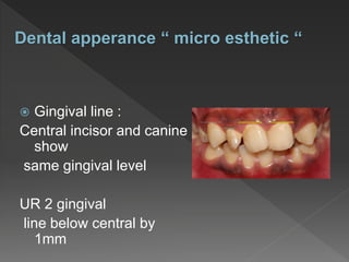  Gingival line :
Central incisor and canine
show
same gingival level
UR 2 gingival
line below central by
1mm
Dental apperance “ micro esthetic “
 