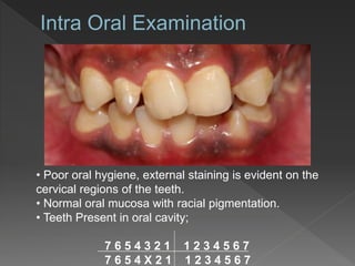 • Poor oral hygiene, external staining is evident on the
cervical regions of the teeth.
• Normal oral mucosa with racial pigmentation.
• Teeth Present in oral cavity;
7 6 5 4 3 2 1 1 2 3 4 5 6 7
7 6 5 4 X 2 1 1 2 3 4 5 6 7
 