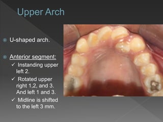  U-shaped arch.
 Anterior segment:
 Instanding upper
left 2.
 Rotated upper
right 1,2, and 3.
And left 1 and 3.
 Midline is shifted
to the left 3 mm.
 