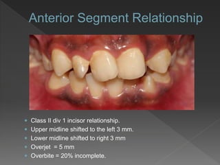  Class II div 1 incisor relationship.
 Upper midline shifted to the left 3 mm.
 Lower midline shifted to right 3 mm
 Overjet = 5 mm
 Overbite = 20% incomplete.
 