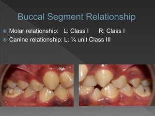  Molar relationship: L: Class I R: Class I
 Canine relationship: L: ¼ unit Class III
 