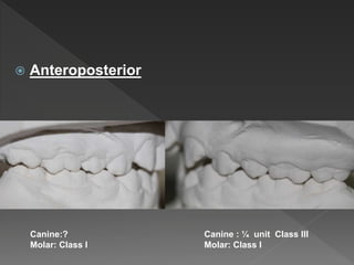  Anteroposterior
Canine:?
Molar: Class I
Canine : ¼ unit Class III
Molar: Class I
 
