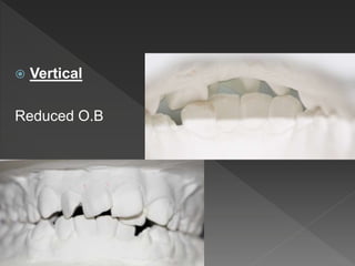  Vertical
Reduced O.B
 