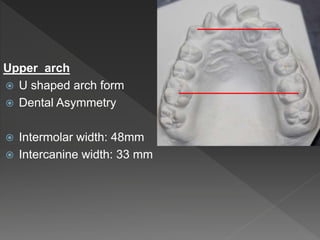 Upper arch
 U shaped arch form
 Dental Asymmetry
 Intermolar width: 48mm
 Intercanine width: 33 mm
 