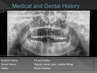 Medical and Dental History
Medical History: Fit and healthy
Dental History: Regular dental visits, multiple fillings
Habits: Mouth breather
 