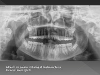 All teeth are present including all third molar buds.
Impacted lower right 3.
 