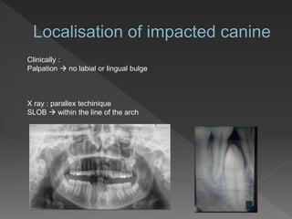 Clinically :
Palpation  no labial or lingual bulge
X ray : parallex techinique
SLOB  within the line of the arch
 