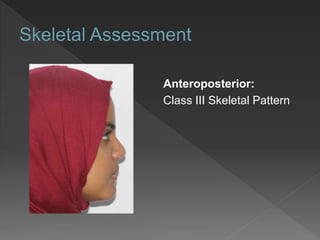 Anteroposterior:
Class III Skeletal Pattern
 