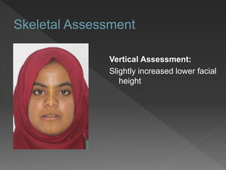 Vertical Assessment:
Slightly increased lower facial
height
 