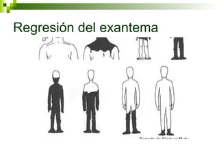 Regresión del exantema 