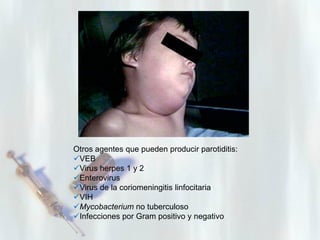 Otros agentes que pueden producir parotiditis:
VEB
Virus herpes 1 y 2
Enterovirus
Virus de la coriomeningitis linfocitaria
VIH
Mycobacterium no tuberculoso
Infecciones por Gram positivo y negativo

 
