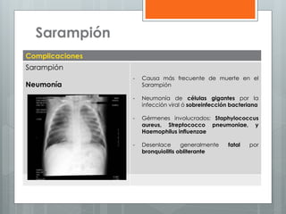 Sarampión
Complicaciones
Sarampión

Neumonía

-

Causa más frecuente de muerte en el
Sarampión

-

Neumonía de células gigantes por la
infección viral ó sobreinfección bacteriana

-

Gérmenes involucrados: Staphylococcus
aureus, Streptococco pneumoniae, y
Haemophilus influenzae

-

Desenlace
generalmente
bronquiolitis obliterante

fatal

por

 