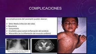 COMPLICACIONES
Las complicaciones del sarampión pueden abarcar:
 Otitis Media (infección del oído)
 Neumonía
 Conjuntivitis
 Encefalitis poco común (inflamación del cerebro)
 Miocarditis (es la inflamación del musculo cardiaco)
 