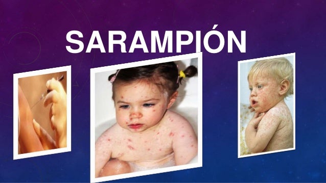 Sarampion