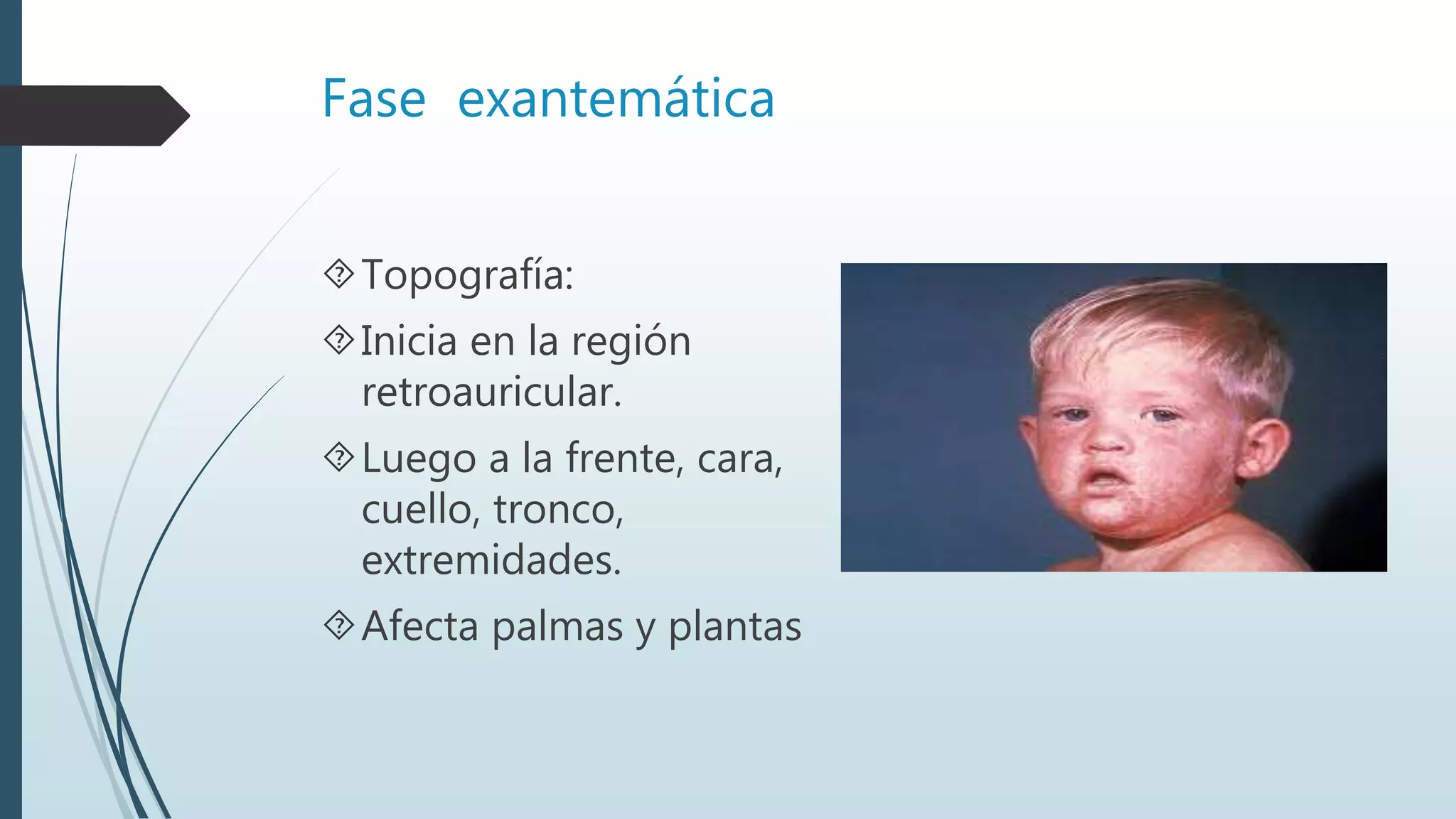 Fase exantemática
Topografía:
Inicia en la región
retroauricular.
Luego a la frente, cara,
cuello, tronco,
extremidades.
Afecta palmas y plantas
 