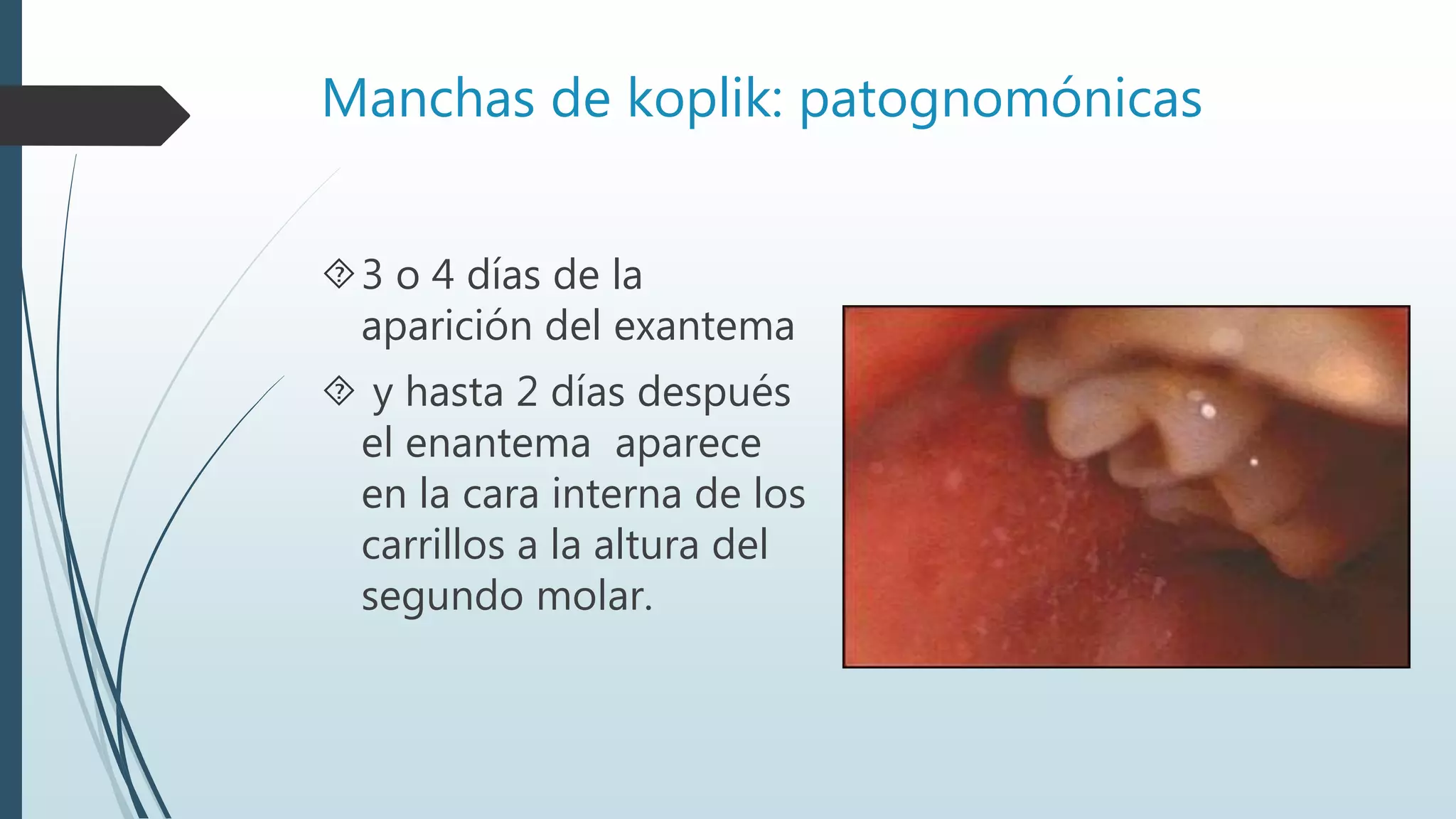 Manchas de koplik: patognomónicas
3 o 4 días de la
aparición del exantema
 y hasta 2 días después
el enantema aparece
en la cara interna de los
carrillos a la altura del
segundo molar.
 
