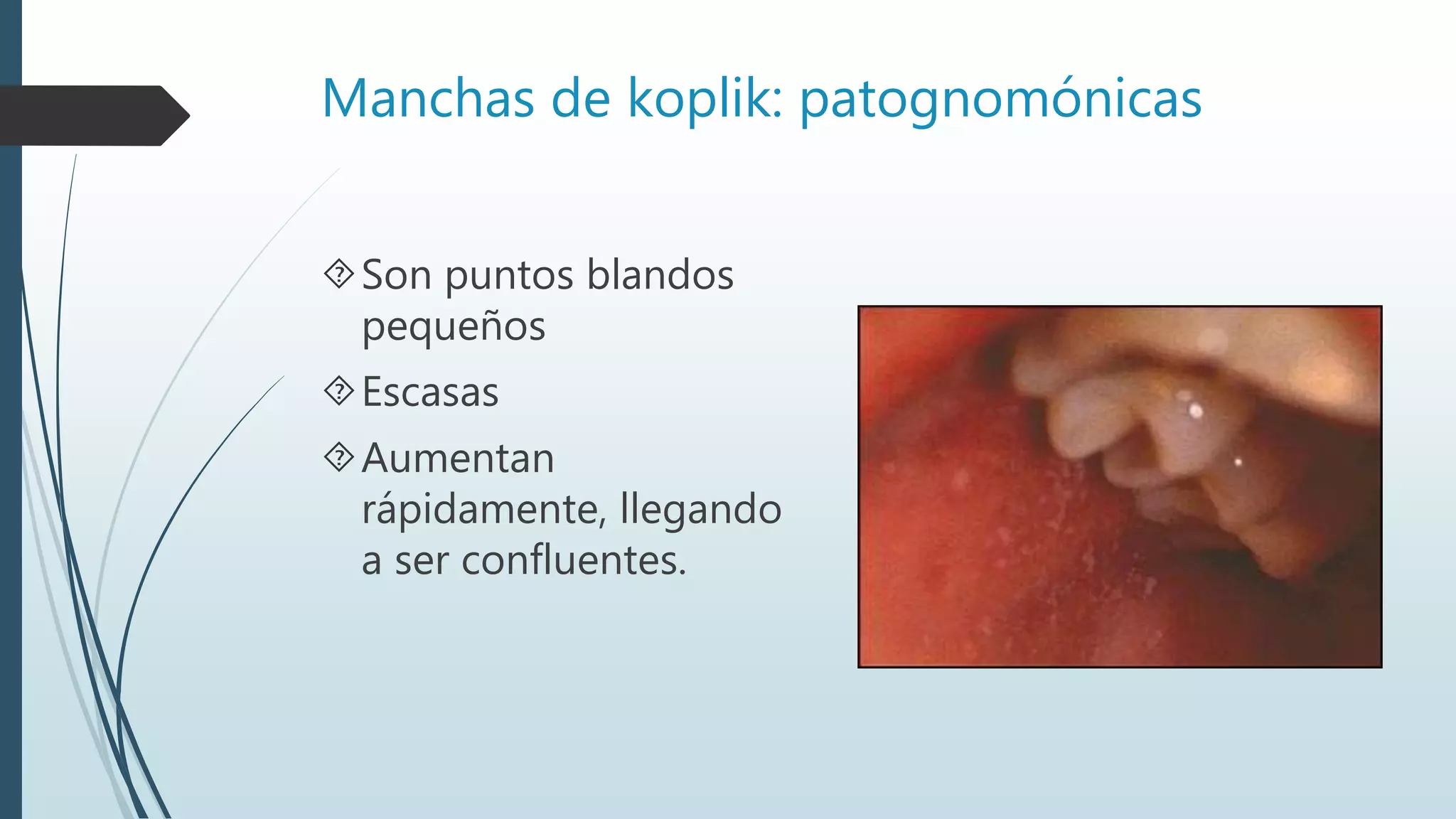 Manchas de koplik: patognomónicas
Son puntos blandos
pequeños
Escasas
Aumentan
rápidamente, llegando
a ser confluentes.
 