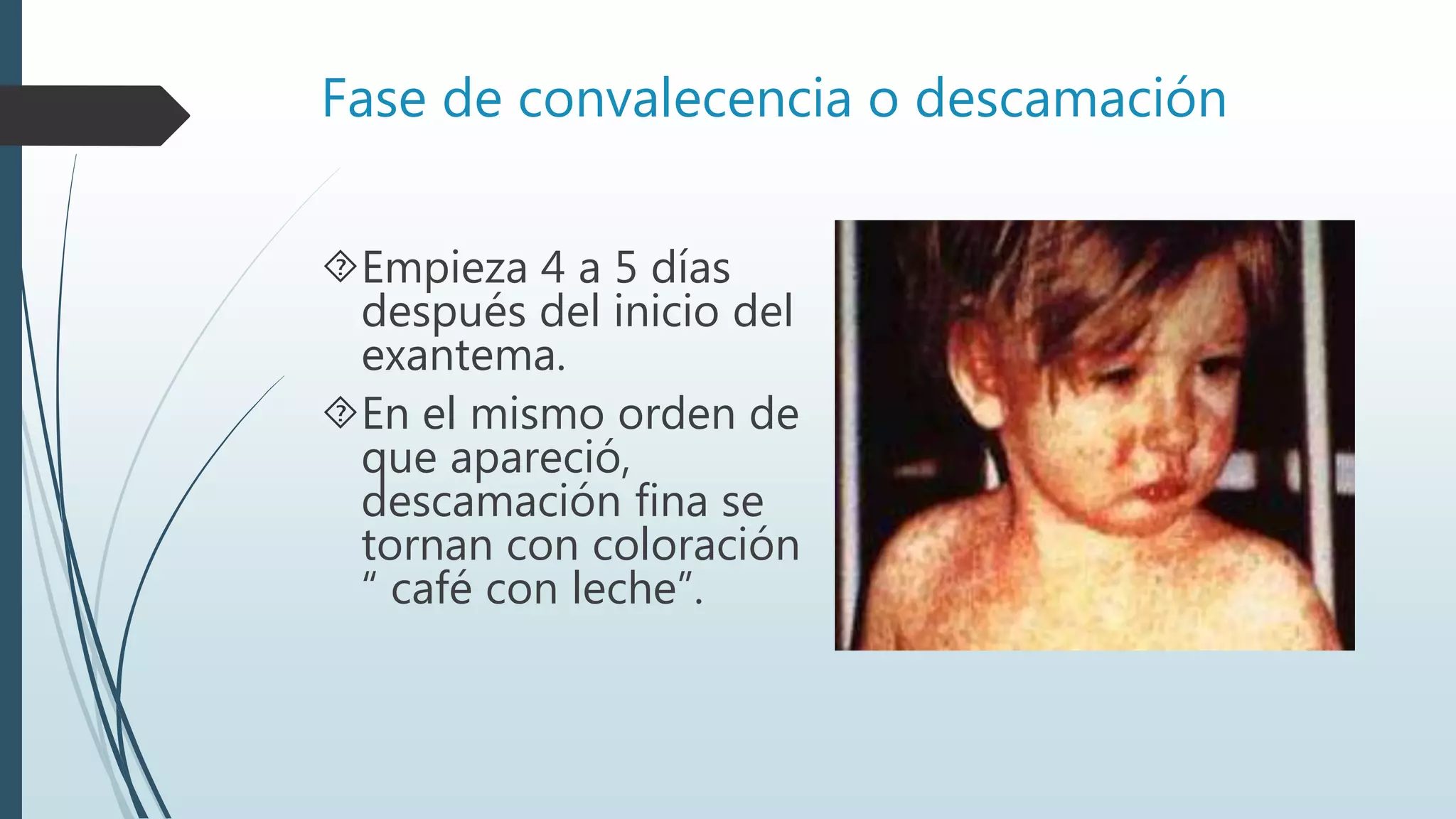 Fase de convalecencia o descamación
Empieza 4 a 5 días
después del inicio del
exantema.
En el mismo orden de
que apareció,
descamación fina se
tornan con coloración
“ café con leche”.
 