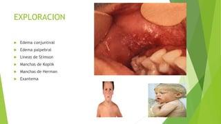 EXPLORACION
 Edema conjuntival
 Edema palpebral
 Lineas de Stimson
 Manchas de Koplik
 Manchas de Herman
 Exantema
 