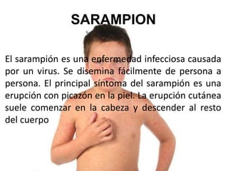 SARAMPION 
El sarampión es una enfermedad infecciosa causada 
por un virus. Se disemina fácilmente de persona a 
persona. El principal síntoma del sarampión es una 
erupción con picazón en la piel. La erupción cutánea 
suele comenzar en la cabeza y descender al resto 
del cuerpo 
 