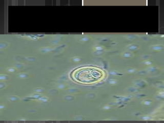 Entamoeba histolitica o amibiasis.
 