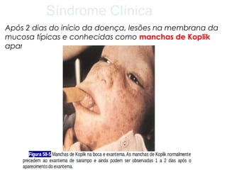 Síndrome Clínica 
Após 2 dias do início da doença, lesões na membrana da 
mucosa típicas e conhecidas como manchas de Koplik 
aparecem. 
 