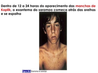 Dentro de 12 a 24 horas do aparecimento das manchas de 
Koplik, o exantema do sarampo começa atrás das orelhas 
e se espalha por todo o corpo. 
 