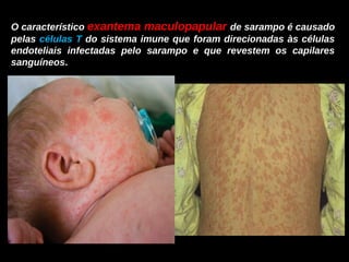 O característico exantema maculopapular de sarampo é causado 
pelas células T do sistema imune que foram direcionadas às células 
endoteliais infectadas pelo sarampo e que revestem os capilares 
sanguíneos. 
 