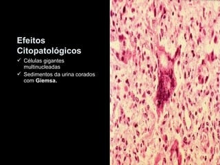 Efeitos 
Citopatológicos 
 Células gigantes 
multinucleadas 
 Sedimentos da urina corados 
com Giemsa. 
 