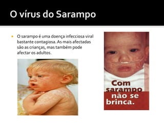 O vírus do SarampoO sarampo é uma doença infecciosa viral bastante contagiosa. As mais afectadas são as crianças, mas também pode afectar os adultos.   