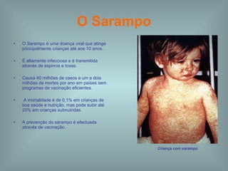 O Sarampo O Sarampo é uma doença viral que atinge principalmente crianças até aos 10 anos. É altamente infecciosa e é transmitida através de espirros e tosse. Causa 40 milhões de casos e um a dois milhões de mortes por ano em países sem programas de vacinação eficientes. A mortalidade é de 0,1% em crianças de boa saúde e nutrição, mas pode subir até 25% em crianças subnutridas.  A prevenção do sarampo é efectuada através de vacinação.  Criança com sarampo 