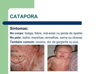 CATAPORA
Sintomas:
No corpo: fadiga, febre, mal-estar ou perda de apetite
Na pele: bolha, manchas vermelhas, sarna ou úlceras
Também comum: coceira, dor de garganta ou pus.
 