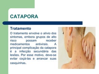 CATAPORA
Tratamento
O tratamento envolve o alívio dos
sintomas, embora grupos de alto
risco possam receber
medicamentos antivirais. A
principal complicação da catapora
é a infecção secundária das
lesões. Por esse motivo, deve-se
evitar coçá-las e arrancar suas
casquinhas.
 