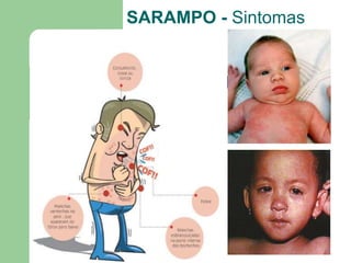 SARAMPO - Sintomas
 
