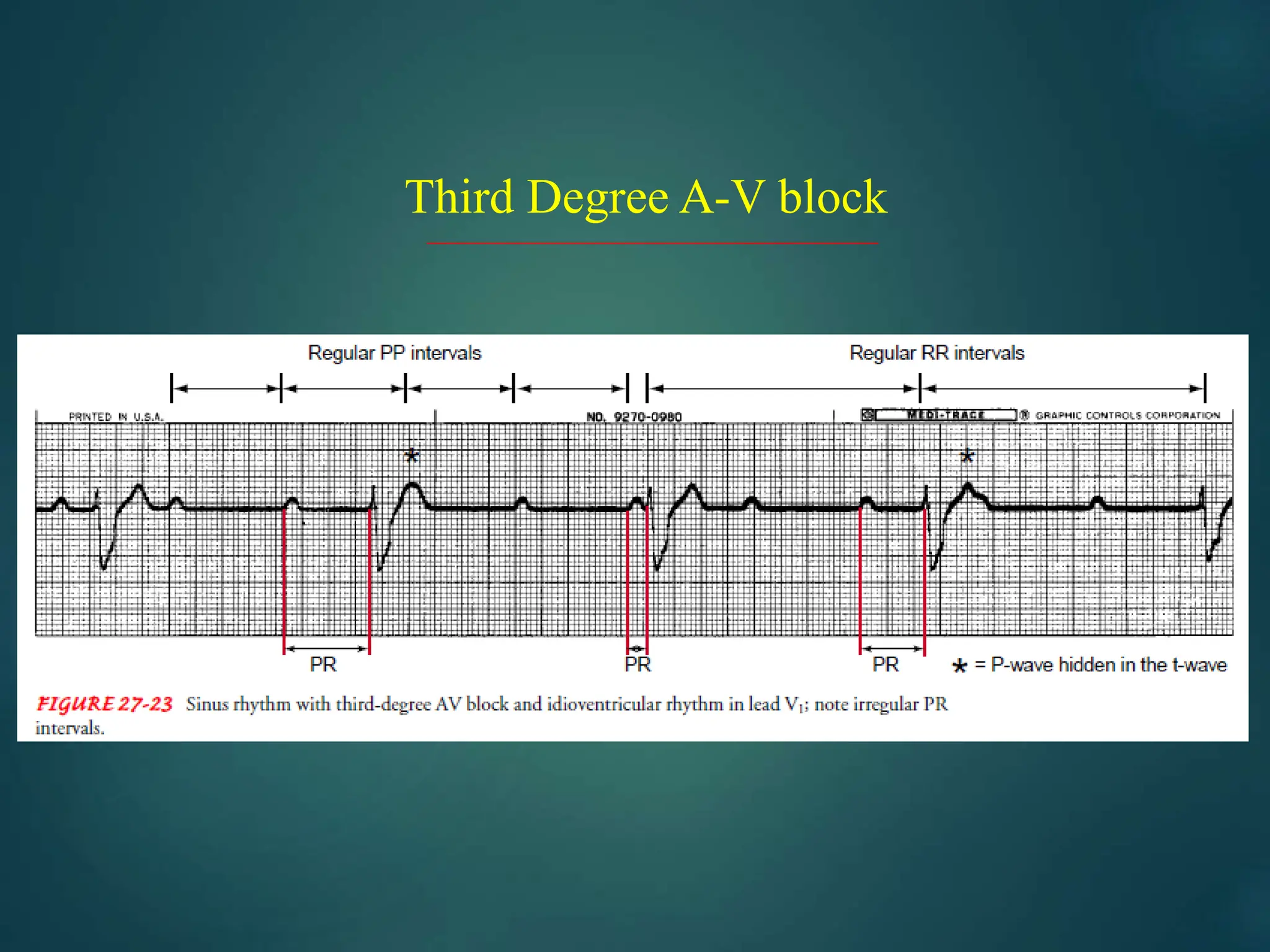 Third Degree A-V block
 