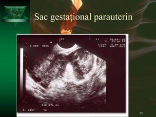 23
Sac gestațional parauterin
 