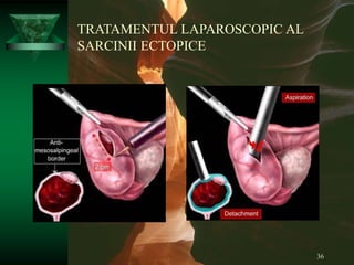 36
TRATAMENTUL LAPAROSCOPIC AL
SARCINII ECTOPICE
 