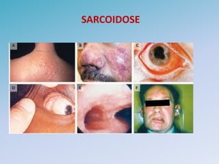 SARCOIDOSE
 