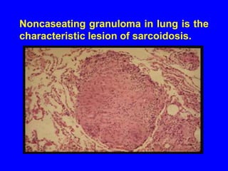 LungsFirst site involvedBegins with alveolitis involving small bronchi and small blood vessels Alveolitis either clears up spontaneously or leads to granuloma Fibrosis