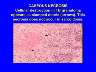 Noncaseating granuloma in lung is the characteristic lesion of sarcoidosis.