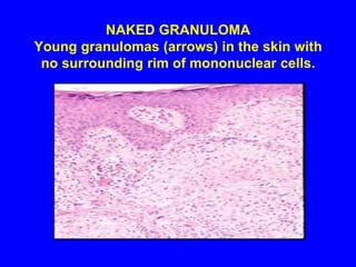 Skin33% have skin lesionsLOFGREN'S SYNDROME; acute triad of erythemanodosum, joint pains, and bilateral hilaradenopathy