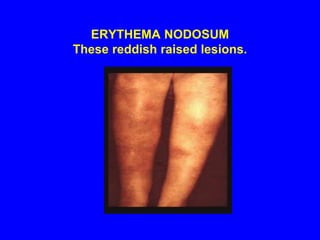 NAKED GRANULOMA Young granulomas (arrows) in the skin with no surrounding rim of mononuclear cells.