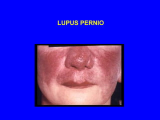 SkinLupus pernio- indurated blue purple swollen shiny lesions on nose, cheeks, lips, ears and fingers. Papules, nodules, and plaques Psoriatic like lesions 