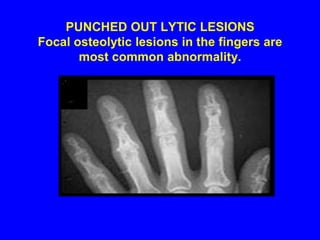 MusculoskeletalAcute polyarthritis with fever is commonArthritis is self limitedChronic destructive bone disease with deformity is rareMuscle disease is rare