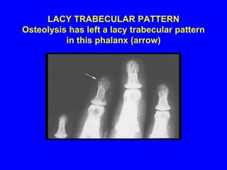 PUNCHED OUT LYTIC LESIONS Focal osteolytic lesions in the fingers are most common abnormality.