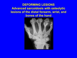 LACY TRABECULAR PATTERN Osteolysis has left a lacy trabecular pattern in this phalanx (arrow)
