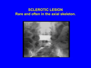 DEFORMING LESIONS Advanced sarcoidosis with osteolytic lesions of the distal forearm, wrist, and bones of the hand