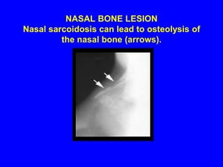 SCLEROTIC LESION Rare and often in the axial skeleton.
